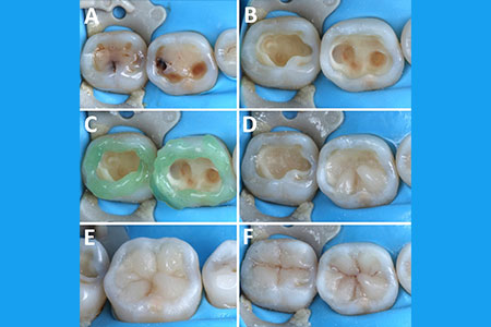 Step-by-step direct composite restoration of mandibular molars