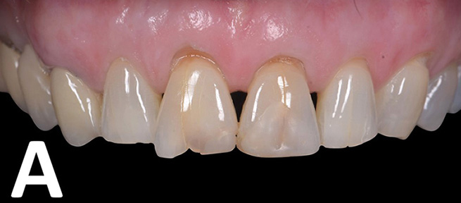 Front view of fractured anterior teeth