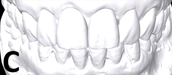 A pre-operative scan of the patient’s teeth 
