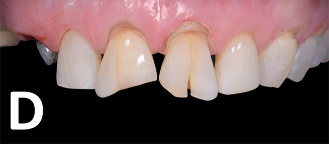 Teeth before veneer preparations 