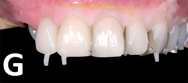 Restorations light cured and retained with interdental separators 