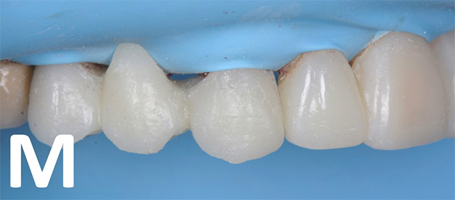 Bridge cemented onto the isolated and primed abutment teeth 