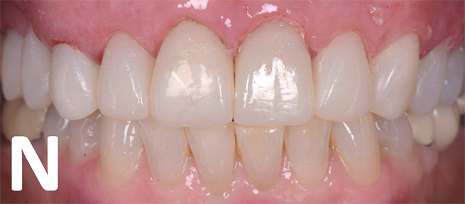 Two week post-operative review of teeth