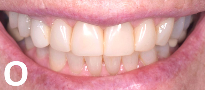 The composite restorations two-years postoperatively 